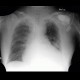 Orotracheal tube, biluminal, intubation: X-ray - Plain radiograph